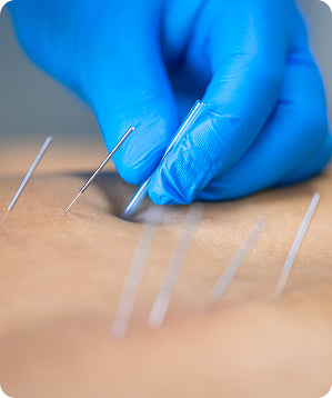 Acupuncture