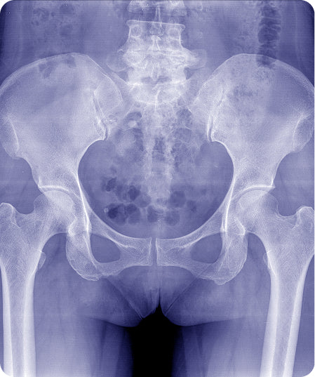 Radiografia de maluc