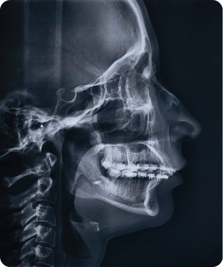 Radiografia de sins paranasals (1 projecció)